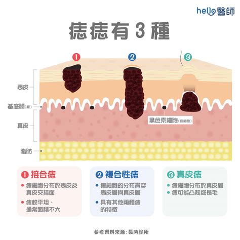 痣長毛|痣形成的原因？痣長毛、痣變多變大是痣病變？5招判。